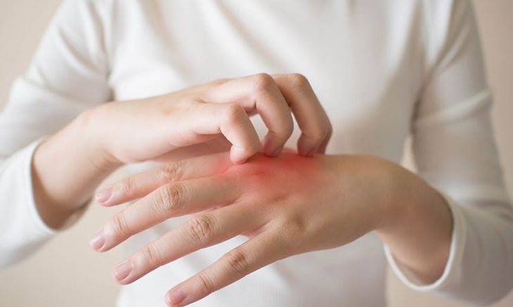 Eczema 730x438 1 730x438