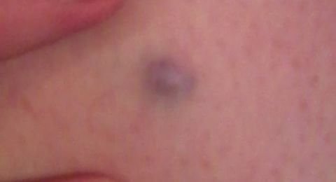 Bb0573px Blue Nevus (crop)